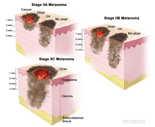 Melanoma Stage 2
