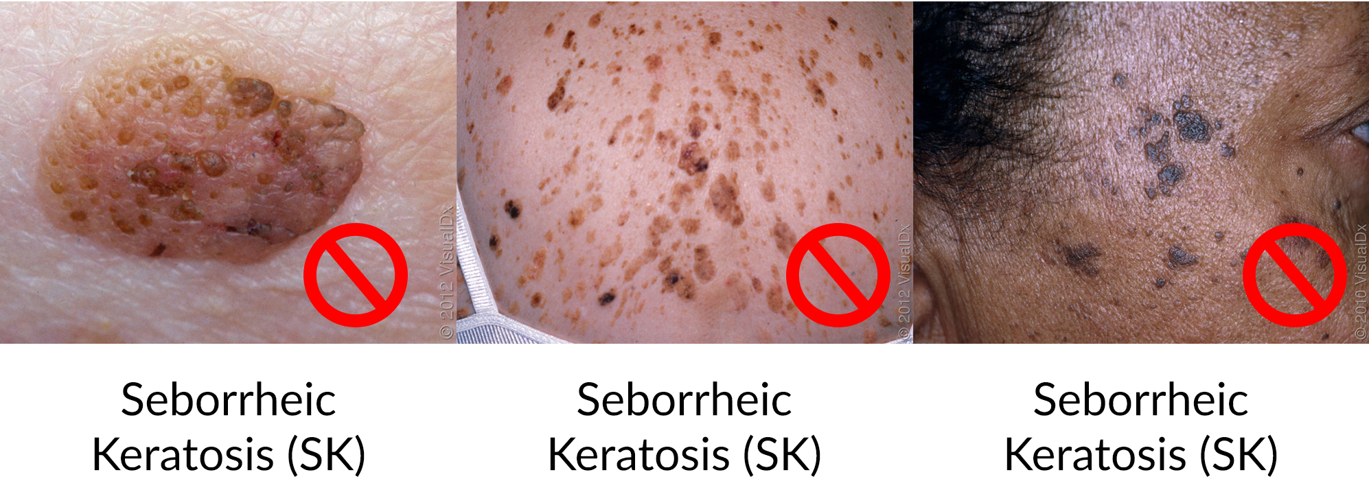 Seborrheic Keratosis (SK)
